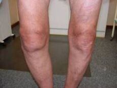 Symptômes d'arthrose de l'articulation du genou