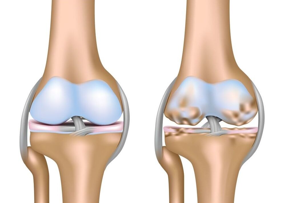 exacerbation de l'arthrose des articulations